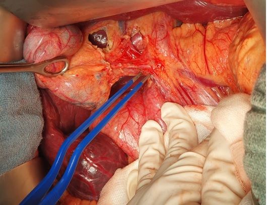 Выделение желчного пузыря и всех элементов гепатодуоденальной связки – воротной вены, печеночной артерии и общего желчного протока