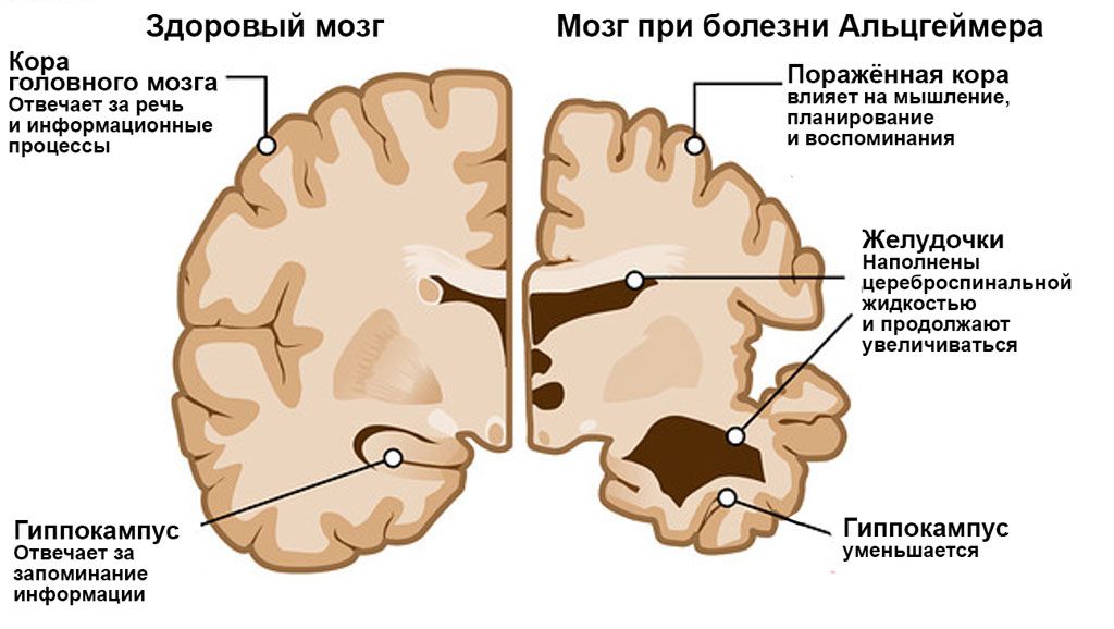 Мозг при болезни Альцгеймера