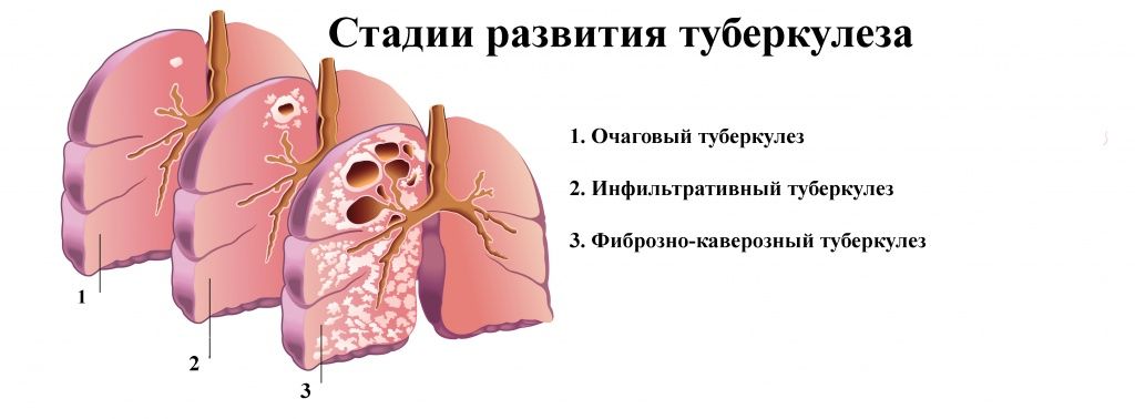 tuberculosis1.jpg