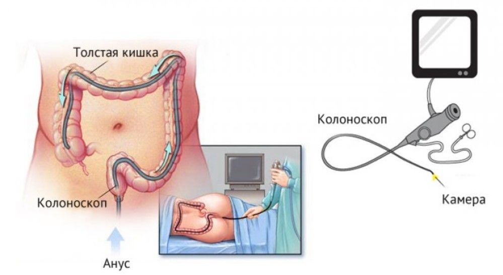 Колоноскопия при синдроме раздраженного кишечника